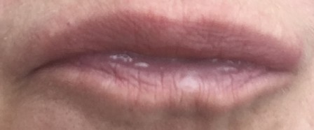 botox.JPG
